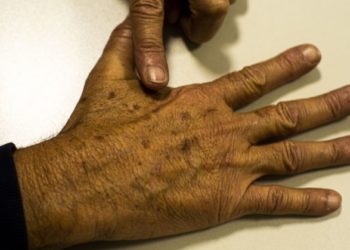 Dezembro Laranja: entenda a campanha para prevenir o câncer de pele
