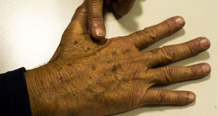 Dezembro Laranja: entenda a campanha para prevenir o câncer de pele