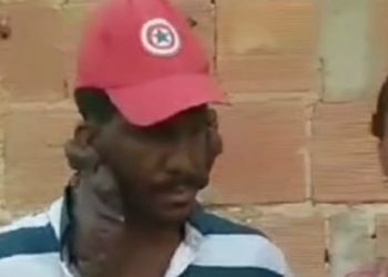 Queloide: o drama de um trabalhador rural de Campos dos Goytacazes que busca tratamento no SUS