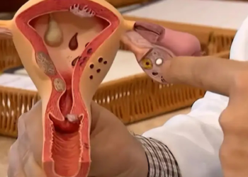 Endometriose: Doença Silenciosa que Afeta 1 em Cada 10 Mulheres