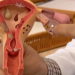 Endometriose: Doença Silenciosa que Afeta 1 em Cada 10 Mulheres