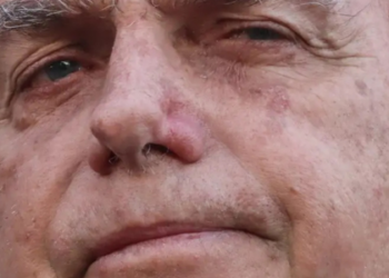 Jair Bolsonaro permanece na UTI após cirurgia no intestino. Boletim aponta piora clínica com alterações hepáticas e pressão alta. Novos exames estão previstos.