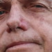 Jair Bolsonaro permanece na UTI após cirurgia no intestino. Boletim aponta piora clínica com alterações hepáticas e pressão alta. Novos exames estão previstos.