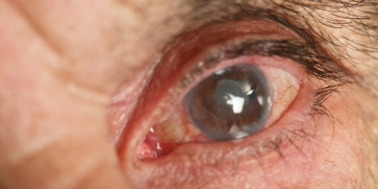Especialistas explicam relação entre pressão intraocular e glaucoma, que levou 85 mil brasileiros à cirurgia em 5 anos. Entenda os sintomas.