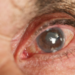 Especialistas explicam relação entre pressão intraocular e glaucoma, que levou 85 mil brasileiros à cirurgia em 5 anos. Entenda os sintomas.
