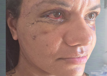 Após ataque brutal, Juliana Garcia compartilha recuperação da cirurgia facial em Natal