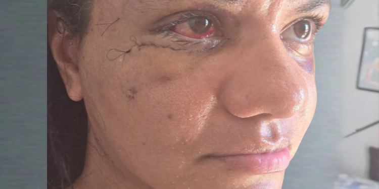 Após ataque brutal, Juliana Garcia compartilha recuperação da cirurgia facial em Natal