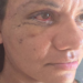 Após ataque brutal, Juliana Garcia compartilha recuperação da cirurgia facial em Natal