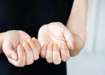 Unhas quebradiças, amareladas, azuladas ou com manchas podem ser sinais de doenças no fígado, rins, coração e até câncer. Saiba quais alterações exigem atenção médica.