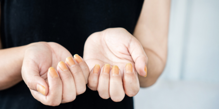 Unhas quebradiças, amareladas, azuladas ou com manchas podem ser sinais de doenças no fígado, rins, coração e até câncer. Saiba quais alterações exigem atenção médica.