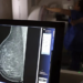 Ministério da Saúde amplia acesso à mamografia no SUS para mulheres a partir dos 40 anos, estende rastreamento até os 74, anuncia novas carretas de saúde e medicamentos modernos contra o câncer de mama.