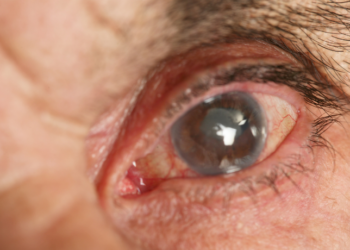 Algoritmo brasileiro identifica glaucoma com imagem única da retina e promete revolucionar o diagnóstico precoce, segundo pesquisa do Hospital de Clínicas de Porto Alegre.