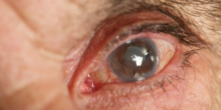Algoritmo brasileiro identifica glaucoma com imagem única da retina e promete revolucionar o diagnóstico precoce, segundo pesquisa do Hospital de Clínicas de Porto Alegre.