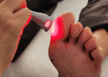 Estudo inédito mostra que a terapia com luz de LED estimula a regeneração dos tecidos e melhora o tratamento de feridas em pés diabéticos, oferecendo nova esperança a milhares de pacientes.