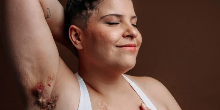 Condições dermatológicas crônicas lideram impacto negativo na qualidade de vida de pacientes