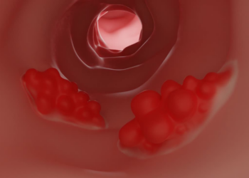 Novo teste experimental analisa bactérias intestinais e pode ampliar o rastreamento do câncer colorretal com menos invasão.