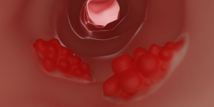 Novo teste experimental analisa bactérias intestinais e pode ampliar o rastreamento do câncer colorretal com menos invasão.