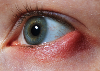 Conjuntivite: como identificar, tratar e prevenir a doença ocular