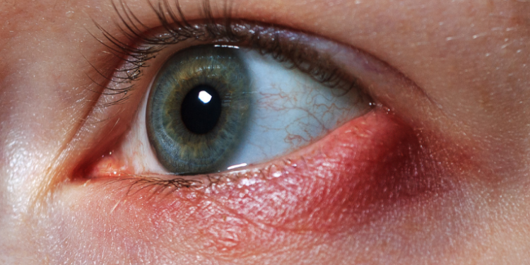 Conjuntivite: como identificar, tratar e prevenir a doença ocular