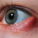 Conjuntivite: como identificar, tratar e prevenir a doença ocular