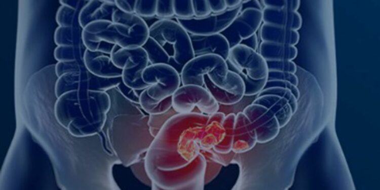 Estudos publicados na Nature Medicine mostram que transplantes fecais podem potencializar a imunoterapia em diferentes tipos de câncer.