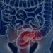 Estudos publicados na Nature Medicine mostram que transplantes fecais podem potencializar a imunoterapia em diferentes tipos de câncer.