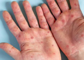 Mpox ainda circula no país e especialistas reforçam cuidados preventivos