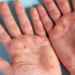 Mpox ainda circula no país e especialistas reforçam cuidados preventivos