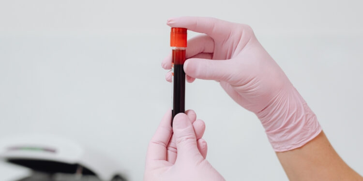 Estudo indica que exame de sangue pode auxiliar médicos na detecção de tumores cerebrais.
