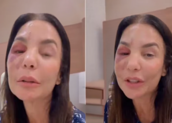 Ivete Sangalo sofreu uma queda em casa devido a uma crise de vertigem, precisou de cirurgia para tratar fratura na face e garante que está bem e em recuperação.