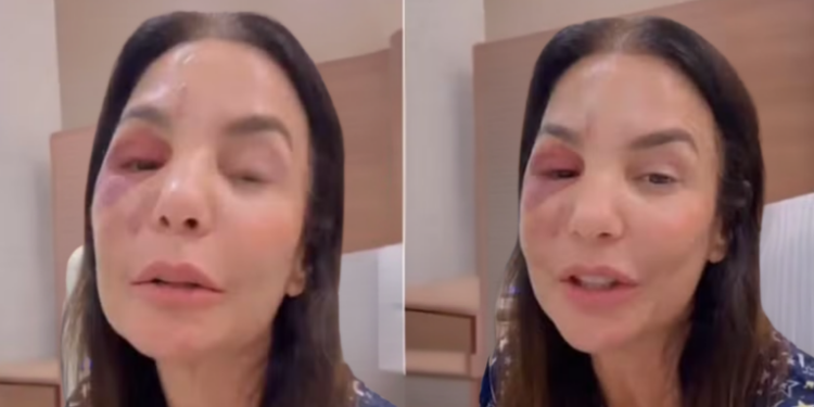 Ivete Sangalo sofreu uma queda em casa devido a uma crise de vertigem, precisou de cirurgia para tratar fratura na face e garante que está bem e em recuperação.