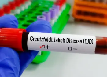Doença de Creutzfeldt-Jakob não tem cura, mas pesquisas investigam novos tratamentos e métodos para diagnóstico mais preciso.
