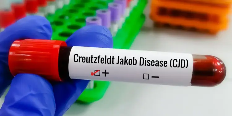 Doença de Creutzfeldt-Jakob não tem cura, mas pesquisas investigam novos tratamentos e métodos para diagnóstico mais preciso.