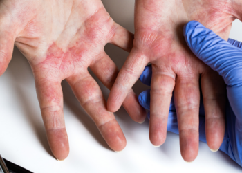 Dermatite atópica pode causar coceira intensa, feridas e impactos no sono e na vida social; tratamento inclui cuidados contínuos com a pele.