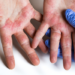 Dermatite atópica pode causar coceira intensa, feridas e impactos no sono e na vida social; tratamento inclui cuidados contínuos com a pele.
