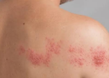 Senado analisa projeto que amplia o acesso à vacina contra herpes-zóster pelo SUS para maiores de 50 anos e adultos imunocomprometidos.