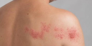 Senado analisa projeto que amplia o acesso à vacina contra herpes-zóster pelo SUS para maiores de 50 anos e adultos imunocomprometidos.