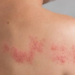 Senado analisa projeto que amplia o acesso à vacina contra herpes-zóster pelo SUS para maiores de 50 anos e adultos imunocomprometidos.