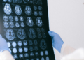 Hospital em Porto Alegre oferece teste sanguíneo para investigar Alzheimer. Exame custa cerca de R$ 3 mil e exige avaliação médica.