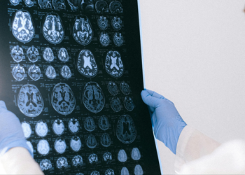 Hospital em Porto Alegre oferece teste sanguíneo para investigar Alzheimer. Exame custa cerca de R$ 3 mil e exige avaliação médica.