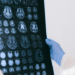 Hospital em Porto Alegre oferece teste sanguíneo para investigar Alzheimer. Exame custa cerca de R$ 3 mil e exige avaliação médica.