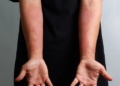 Asma e dermatite atópica podem compartilhar mecanismos inflamatórios. Conheça a inflamação tipo 2 e seus tratamentos.