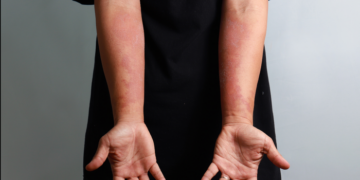 Asma e dermatite atópica podem compartilhar mecanismos inflamatórios. Conheça a inflamação tipo 2 e seus tratamentos.
