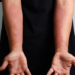 Asma e dermatite atópica podem compartilhar mecanismos inflamatórios. Conheça a inflamação tipo 2 e seus tratamentos.