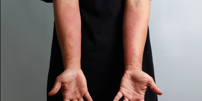 Asma e dermatite atópica podem compartilhar mecanismos inflamatórios. Conheça a inflamação tipo 2 e seus tratamentos.